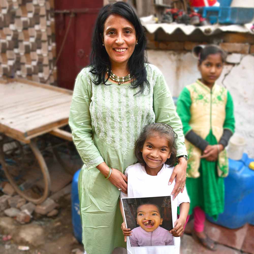 Mamta with Smile Train patient