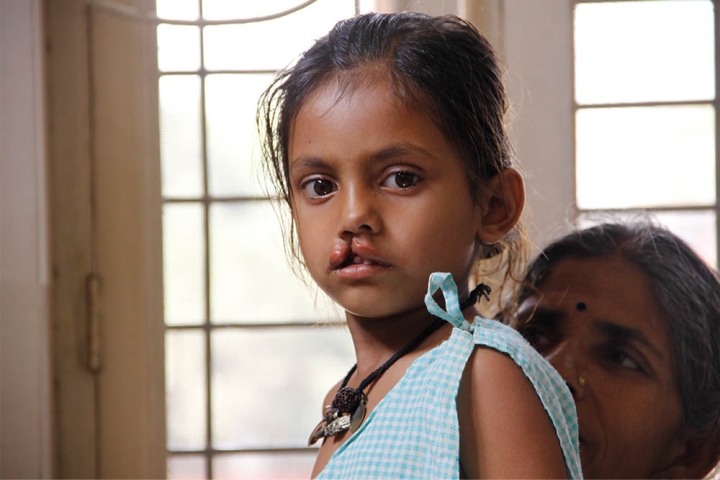 Girl with cleft lip