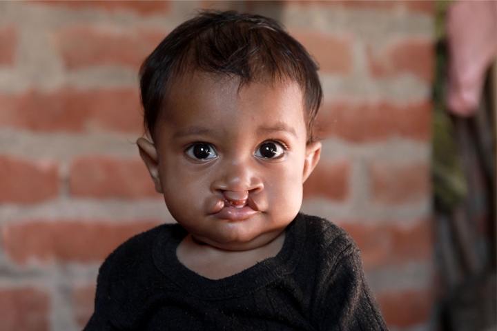 Babies with Clefts Need Your Support