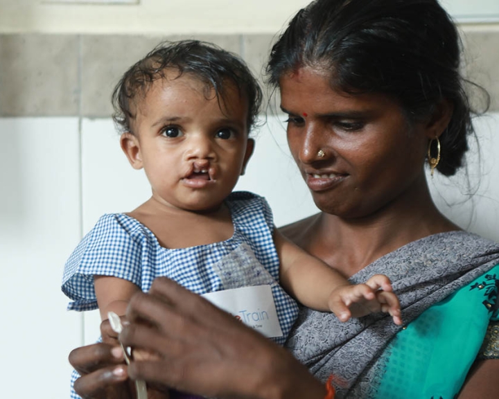 child with bilateral cleft lip