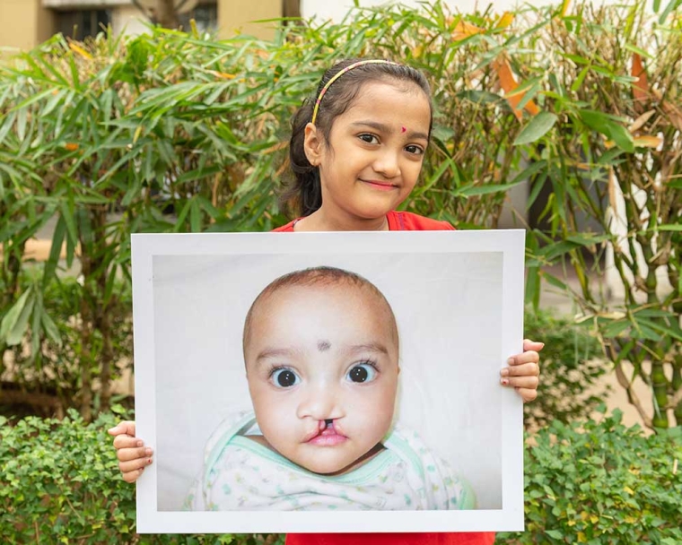 girl holds up image of herself before cleft lip surgery