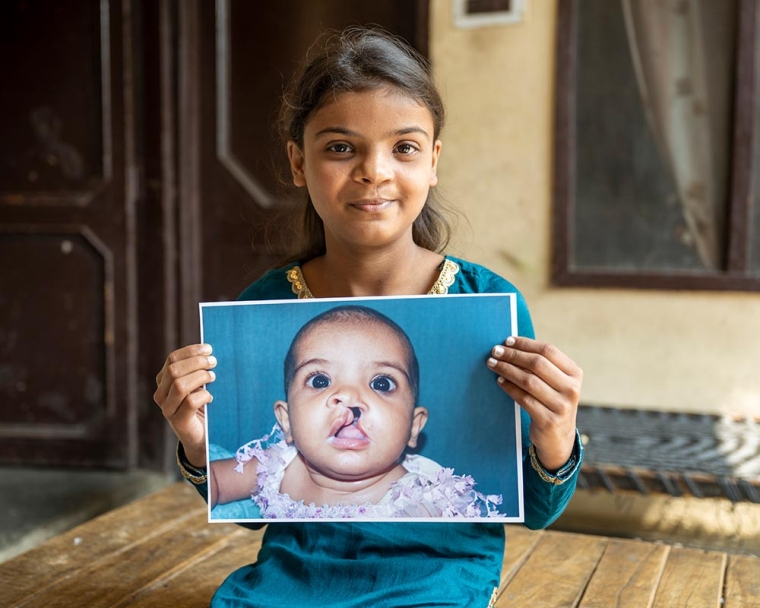 girl holds up image of herself before cleft lip surgery